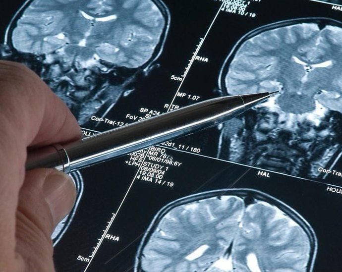 treatment of Alzheimer's disease